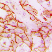 Immunohistochemical analysis of CD61 staining in human breast cancer formalin fixed paraffin embedded tissue section. The section was pre-treated using heat mediated antigen retrieval with sodium citrate buffer (pH 6.0). The section was then incubated with the antibody at room temperature and detected using an HRP conjugated compact polymer system. DAB was used as the chromogen. The section was then counterstained with haematoxylin and mounted with DPX.
