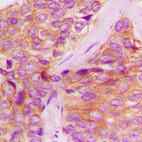 Immunohistochemical analysis of JAK1 (pY1022) staining in human breast cancer formalin fixed paraffin embedded tissue section. The section was pre-treated using heat mediated antigen retrieval with sodium citrate buffer (pH 6.0). The section was then incubated with the antibody at room temperature and detected using an HRP conjugated compact polymer system. DAB was used as the chromogen. The section was then counterstained with haematoxylin and mounted with DPX.