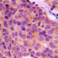 Immunohistochemical analysis of Cytokeratin 17 staining in human breast cancer formalin fixed paraffin embedded tissue section. The section was pre-treated using heat mediated antigen retrieval with sodium citrate buffer (pH 6.0). The section was then incubated with the antibody at room temperature and detected using an HRP conjugated compact polymer system. DAB was used as the chromogen. The section was then counterstained with haematoxylin and mounted with DPX.