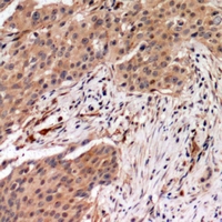 Immunohistochemical analysis of MYPT1 (pT696) staining in human breast cancer formalin fixed paraffin embedded tissue section. The section was pre-treated using heat mediated antigen retrieval with sodium citrate buffer (pH 6.0). The section was then incubated with the antibody at room temperature and detected using an HRP conjugacompact polymer system. DAB was used as the chromogen. The section was then counterstained with haematoxylin and mounted with DPX.