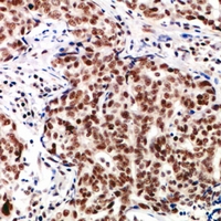 Immunohistochemical analysis of TP53INP2 staining in human breast cancer formalin fixed paraffin embedded tissue section. The section was pre-treated using heat mediated antigen retrieval with sodium citrate buffer (pH 6.0). The section was then incubated with the antibody at room temperature and detected using an HRP conjugacompact polymer system. DAB was used as the chromogen. The section was then counterstained with haematoxylin and mounted with DPX.
