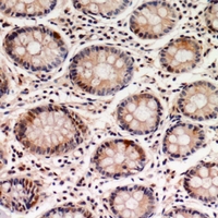 Immunohistochemical analysis of GTPBP2 staining in human colon cancer formalin fixed paraffin embedded tissue section. The section was pre-treated using heat mediated antigen retrieval with sodium citrate buffer (pH 6.0). The section was then incubated with the antibody at room temperature and detected using an HRP conjugacompact polymer system. DAB was used as the chromogen. The section was then counterstained with haematoxylin and mounted with DPX.