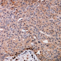 Immunohistochemical analysis of TRAK2 staining in human breast cancer formalin fixed paraffin embedded tissue section. The section was pre-treated using heat mediated antigen retrieval with sodium citrate buffer (pH 6.0). The section was then incubated with the antibody at room temperature and detected using an HRP conjugacompact polymer system. DAB was used as the chromogen. The section was then counterstained with haematoxylin and mounted with DPX.