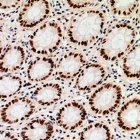 Immunohistochemical analysis of ZNF839 staining in human colon cancer formalin fixed paraffin embedded tissue section. The section was pre-treated using heat mediated antigen retrieval with sodium citrate buffer (pH 6.0). The section was then incubated with the antibody at room temperature and detected using an HRP conjugacompact polymer system. DAB was used as the chromogen. The section was then counterstained with haematoxylin and mounted with DPX.