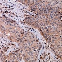 Immunohistochemical analysis of VPS54 staining in human breast cancer formalin fixed paraffin embedded tissue section. The section was pre-treated using heat mediated antigen retrieval with sodium citrate buffer (pH 6.0). The section was then incubated with the antibody at room temperature and detected using an HRP conjugacompact polymer system. DAB was used as the chromogen. The section was then counterstained with haematoxylin and mounted with DPX.