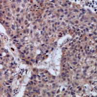 Immunohistochemical analysis of SETMAR staining in human lung cancer formalin fixed paraffin embedded tissue section. The section was pre-treated using heat mediated antigen retrieval with sodium citrate buffer (pH 6.0). The section was then incubated with the antibody at room temperature and detected using an HRP conjugacompact polymer system. DAB was used as the chromogen. The section was then counterstained with haematoxylin and mounted with DPX.