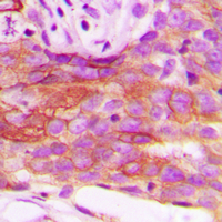 Immunohistochemical analysis of HSL staining in human breast cancer formalin fixed paraffin embedded tissue section. The section was pre-treated using heat mediated antigen retrieval with sodium citrate buffer (pH 6.0). The section was then incubated with the antibody at room temperature and detected using an HRP conjugated compact polymer system. DAB was used as the chromogen. The section was then counterstained with haematoxylin and mounted with DPX.