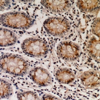 Immunohistochemical analysis of NTPCR staining in human colon cancer formalin fixed paraffin embedded tissue section. The section was pre-treated using heat mediated antigen retrieval with sodium citrate buffer (pH 6.0). The section was then incubated with the antibody at room temperature and detected using an HRP conjugacompact polymer system. DAB was used as the chromogen. The section was then counterstained with haematoxylin and mounted with DPX.