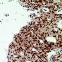 Immunohistochemical analysis of CNOT7 staining in human ovarian cancer formalin fixed paraffin embedded tissue section. The section was pre-treated using heat mediated antigen retrieval with sodium citrate buffer (pH 6.0). The section was then incubated with the antibody at room temperature and detected using an HRP conjugacompact polymer system. DAB was used as the chromogen. The section was then counterstained with haematoxylin and mounted with DPX.