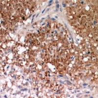 Immunohistochemical analysis of Catenin delta 1 staining in human breast cancer formalin fixed paraffin embedded tissue section. The section was pre-treated using heat mediated antigen retrieval with sodium citrate buffer (pH 6.0). The section was then incubated with the antibody at room temperature and detected using an HRP conjugacompact polymer system. DAB was used as the chromogen. The section was then counterstained with haematoxylin and mounted with DPX.
