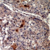 Immunohistochemical analysis of TRIF staining in human lung cancer formalin fixed paraffin embedded tissue section. The section was pre-treated using heat mediated antigen retrieval with sodium citrate buffer (pH 6.0). The section was then incubated with the antibody at room temperature and detected using an HRP conjugacompact polymer system. DAB was used as the chromogen. The section was then counterstained with haematoxylin and mounted with DPX.