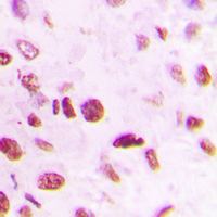 Immunohistochemical analysis of SMAD6 staining in human lung cancer formalin fixed paraffin embedded tissue section. The section was pre-treated using heat mediated antigen retrieval with sodium citrate buffer (pH 6.0). The section was then incubated with the antibody at room temperature and detected using an HRP conjugated compact polymer system. DAB was used as the chromogen. The section was then counterstained with haematoxylin and mounted with DPX.