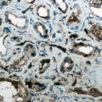 Immunohistochemical analysis of Aquaporin 4 staining in human lung cancer formalin fixed paraffin embedded tissue section. The section was pre-treated using heat mediated antigen retrieval with sodium citrate buffer (pH 6.0). The section was then incubated with the antibody at room temperature and detected using an HRP conjugated compact polymer system. DAB was used as the chromogen. The section was then counterstained with haematoxylin and mounted with DPX.