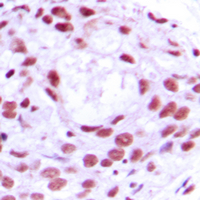 Immunohistochemical analysis of MCM4 staining in human breast cancer formalin fixed paraffin embedded tissue section. The section was pre-treated using heat mediated antigen retrieval with sodium citrate buffer (pH 6.0). The section was then incubated with the antibody at room temperature and detected using an HRP conjugated compact polymer system. DAB was used as the chromogen. The section was then counterstained with haematoxylin and mounted with DPX.