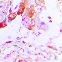 Immunohistochemical analysis of Aquaporin 5 staining in human lung cancer formalin fixed paraffin embedded tissue section. The section was pre-treated using heat mediated antigen retrieval with sodium citrate buffer (pH 6.0). The section was then incubated with the antibody at room temperature and detected using an HRP conjugated compact polymer system. DAB was used as the chromogen. The section was then counterstained with haematoxylin and mounted with DPX.