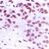 Immunohistochemical analysis of MEOX2 staining in human breast cancer formalin fixed paraffin embedded tissue section. The section was pre-treated using heat mediated antigen retrieval with sodium citrate buffer (pH 6.0). The section was then incubated with the antibody at room temperature and detected using an HRP conjugated compact polymer system. DAB was used as the chromogen. The section was then counterstained with haematoxylin and mounted with DPX.