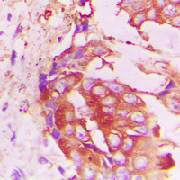 Immunohistochemical analysis of RhoH staining in human lung cancer formalin fixed paraffin embedded tissue section. The section was pre-treated using heat mediated antigen retrieval with sodium citrate buffer (pH 6.0). The section was then incubated with the antibody at room temperature and detected using an HRP conjugated compact polymer system. DAB was used as the chromogen. The section was then counterstained with haematoxylin and mounted with DPX.