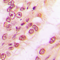 Immunohistochemical analysis of PAWR staining in human breast cancer formalin fixed paraffin embedded tissue section. The section was pre-treated using heat mediated antigen retrieval with sodium citrate buffer (pH 6.0). The section was then incubated with the antibody at room temperature and detected using an HRP conjugated compact polymer system. DAB was used as the chromogen. The section was then counterstained with haematoxylin and mounted with DPX.