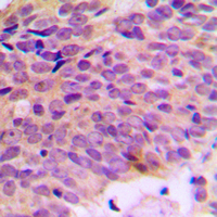 Immunohistochemical analysis of ATP5A1 staining in human breast cancer formalin fixed paraffin embedded tissue section. The section was pre-treated using heat mediated antigen retrieval with sodium citrate buffer (pH 6.0). The section was then incubated with the antibody at room temperature and detected using an HRP conjugated compact polymer system. DAB was used as the chromogen. The section was then counterstained with haematoxylin and mounted with DPX.