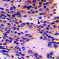 Immunohistochemical analysis of PEX7 staining in human breast cancer formalin fixed paraffin embedded tissue section. The section was pre-treated using heat mediated antigen retrieval with sodium citrate buffer (pH 6.0). The section was then incubated with the antibody at room temperature and detected using an HRP conjugated compact polymer system. DAB was used as the chromogen. The section was then counterstained with haematoxylin and mounted with DPX.