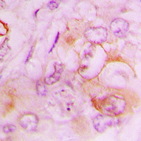 Immunohistochemical analysis of Serpin B9 staining in human lung cancer formalin fixed paraffin embedded tissue section. The section was pre-treated using heat mediated antigen retrieval with sodium citrate buffer (pH 6.0). The section was then incubated with the antibody at room temperature and detected using an HRP conjugated compact polymer system. DAB was used as the chromogen. The section was then counterstained with haematoxylin and mounted with DPX.
