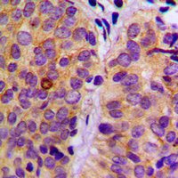 Immunohistochemical analysis of PLC gamma 2 (pY753) staining in human breast cancer formalin fixed paraffin embedded tissue section. The section was pre-treated using heat mediated antigen retrieval with sodium citrate buffer (pH 6.0). The section was then incubated with the antibody at room temperature and detected using an HRP conjugated compact polymer system. DAB was used as the chromogen. The section was then counterstained with haematoxylin and mounted with DPX.