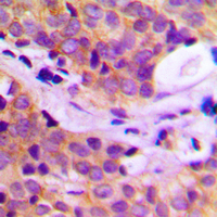 Immunohistochemical analysis of PLC gamma 2 staining in human breast cancer formalin fixed paraffin embedded tissue section. The section was pre-treated using heat mediated antigen retrieval with sodium citrate buffer (pH 6.0). The section was then incubated with the antibody at room temperature and detected using an HRP conjugated compact polymer system. DAB was used as the chromogen. The section was then counterstained with haematoxylin and mounted with DPX.