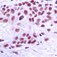 Immunohistochemical analysis of TRAP220 staining in human breast cancer formalin fixed paraffin embedded tissue section. The section was pre-treated using heat mediated antigen retrieval with sodium citrate buffer (pH 6.0). The section was then incubated with the antibody at room temperature and detected using an HRP conjugated compact polymer system. DAB was used as the chromogen. The section was then counterstained with haematoxylin and mounted with DPX.