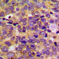 Immunohistochemical analysis of PRKAR2B staining in human breast cancer formalin fixed paraffin embedded tissue section. The section was pre-treated using heat mediated antigen retrieval with sodium citrate buffer (pH 6.0). The section was then incubated with the antibody at room temperature and detected using an HRP conjugated compact polymer system. DAB was used as the chromogen. The section was then counterstained with haematoxylin and mounted with DPX.