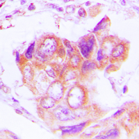 Immunohistochemical analysis of PSMD2 staining in human lung cancer formalin fixed paraffin embedded tissue section. The section was pre-treated using heat mediated antigen retrieval with sodium citrate buffer (pH 6.0). The section was then incubated with the antibody at room temperature and detected using an HRP conjugated compact polymer system. DAB was used as the chromogen. The section was then counterstained with haematoxylin and mounted with DPX.