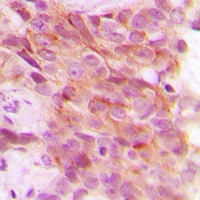 Immunohistochemical analysis of PSMD12 staining in human breast cancer formalin fixed paraffin embedded tissue section. The section was pre-treated using heat mediated antigen retrieval with sodium citrate buffer (pH 6.0). The section was then incubated with the antibody at room temperature and detected using an HRP conjugated compact polymer system. DAB was used as the chromogen. The section was then counterstained with haematoxylin and mounted with DPX.