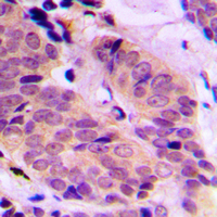 Immunohistochemical analysis of ABCD4 staining in human breast cancer formalin fixed paraffin embedded tissue section. The section was pre-treated using heat mediated antigen retrieval with sodium citrate buffer (pH 6.0). The section was then incubated with the antibody at room temperature and detected using an HRP conjugated compact polymer system. DAB was used as the chromogen. The section was then counterstained with haematoxylin and mounted with DPX.