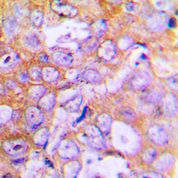 Immunohistochemical analysis of Beta-actin staining in human lung cancer formalin fixed paraffin embedded tissue section. The section was pre-treated using heat mediated antigen retrieval with sodium citrate buffer (pH 6.0). The section was then incubated with the antibody at room temperature and detected using an HRP conjugated compact polymer system. DAB was used as the chromogen. The section was then counterstained with haematoxylin and mounted with DPX.