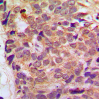Immunohistochemical analysis of RGS10 staining in human breast cancer formalin fixed paraffin embedded tissue section. The section was pre-treated using heat mediated antigen retrieval with sodium citrate buffer (pH 6.0). The section was then incubated with the antibody at room temperature and detected using an HRP conjugated compact polymer system. DAB was used as the chromogen. The section was then counterstained with haematoxylin and mounted with DPX.