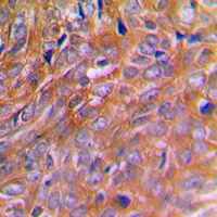 Immunohistochemical analysis of BNIP2 staining in human breast cancer formalin fixed paraffin embedded tissue section. The section was pre-treated using heat mediated antigen retrieval with sodium citrate buffer (pH 6.0). The section was then incubated with the antibody at room temperature and detected using an HRP conjugated compact polymer system. DAB was used as the chromogen. The section was then counterstained with haematoxylin and mounted with DPX.