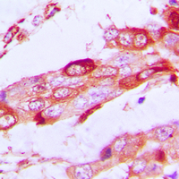 Immunohistochemical analysis of SSBP1 staining in human lung cancer formalin fixed paraffin embedded tissue section. The section was pre-treated using heat mediated antigen retrieval with sodium citrate buffer (pH 6.0). The section was then incubated with the antibody at room temperature and detected using an HRP conjugated compact polymer system. DAB was used as the chromogen. The section was then counterstained with haematoxylin and mounted with DPX.