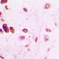 Immunohistochemical analysis of AP2 alpha/beta staining in human lung cancer formalin fixed paraffin embedded tissue section. The section was pre-treated using heat mediated antigen retrieval with sodium citrate buffer (pH 6.0). The section was then incubated with the antibody at room temperature and detected using an HRP conjugated compact polymer system. DAB was used as the chromogen. The section was then counterstained with haematoxylin and mounted with DPX.