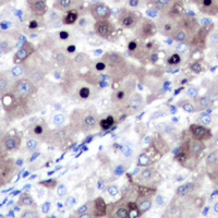 Immunohistochemical analysis of Topoisomerase 2 alpha staining in human liver cancer formalin fixed paraffin embedded tissue section. The section was pre-treated using heat mediated antigen retrieval with sodium citrate buffer (pH 6.0). The section was then incubated with the antibody at room temperature and detected using an HRP conjugated compact polymer system. DAB was used as the chromogen. The section was then counterstained with haematoxylin and mounted with DPX.