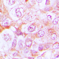 Immunohistochemical analysis of Complement C6 staining in human lung cancer formalin fixed paraffin embedded tissue section. The section was pre-treated using heat mediated antigen retrieval with sodium citrate buffer (pH 6.0). The section was then incubated with the antibody at room temperature and detected using an HRP conjugated compact polymer system. DAB was used as the chromogen. The section was then counterstained with haematoxylin and mounted with DPX.