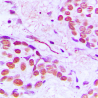 Immunohistochemical analysis of Gamma-tubulin staining in human breast cancer formalin fixed paraffin embedded tissue section. The section was pre-treated using heat mediated antigen retrieval with sodium citrate buffer (pH 6.0). The section was then incubated with the antibody at room temperature and detected using an HRP conjugated compact polymer system. DAB was used as the chromogen. The section was then counterstained with haematoxylin and mounted with DPX.