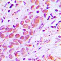 Immunohistochemical analysis of USF2 staining in human breast cancer formalin fixed paraffin embedded tissue section. The section was pre-treated using heat mediated antigen retrieval with sodium citrate buffer (pH 6.0). The section was then incubated with the antibody at room temperature and detected using an HRP conjugated compact polymer system. DAB was used as the chromogen. The section was then counterstained with haematoxylin and mounted with DPX.