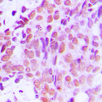 Immunohistochemical analysis of XRCC1 staining in human breast cancer formalin fixed paraffin embedded tissue section. The section was pre-treated using heat mediated antigen retrieval with sodium citrate buffer (pH 6.0). The section was then incubated with the antibody at room temperature and detected using an HRP conjugated compact polymer system. DAB was used as the chromogen. The section was then counterstained with haematoxylin and mounted with DPX.