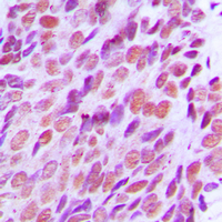 Immunohistochemical analysis of XRCC2 staining in human breast cancer formalin fixed paraffin embedded tissue section. The section was pre-treated using heat mediated antigen retrieval with sodium citrate buffer (pH 6.0). The section was then incubated with the antibody at room temperature and detected using an HRP conjugated compact polymer system. DAB was used as the chromogen. The section was then counterstained with haematoxylin and mounted with DPX.