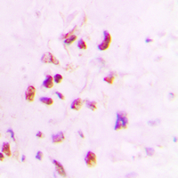 Immunohistochemical analysis of XRCC3 staining in human lung cancer formalin fixed paraffin embedded tissue section. The section was pre-treated using heat mediated antigen retrieval with sodium citrate buffer (pH 6.0). The section was then incubated with the antibody at room temperature and detected using an HRP conjugated compact polymer system. DAB was used as the chromogen. The section was then counterstained with haematoxylin and mounted with DPX.