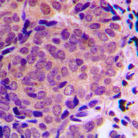 Immunohistochemical analysis of ALMS1 staining in human breast cancer formalin fixed paraffin embedded tissue section. The section was pre-treated using heat mediated antigen retrieval with sodium citrate buffer (pH 6.0). The section was then incubated with the antibody at room temperature and detected using an HRP conjugated compact polymer system. DAB was used as the chromogen. The section was then counterstained with haematoxylin and mounted with DPX.