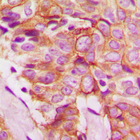 Immunohistochemical analysis of Frizzled 8 staining in human breast cancer formalin fixed paraffin embedded tissue section. The section was pre-treated using heat mediated antigen retrieval with sodium citrate buffer (pH 6.0). The section was then incubated with the antibody at room temperature and detected using an HRP conjugated compact polymer system. DAB was used as the chromogen. The section was then counterstained with haematoxylin and mounted with DPX.
