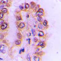Immunohistochemical analysis of Cytochrome P450 4F2 staining in human liver cancer formalin fixed paraffin embedded tissue section. The section was pre-treated using heat mediated antigen retrieval with sodium citrate buffer (pH 6.0). The section was then incubated with the antibody at room temperature and detected using an HRP conjugated compact polymer system. DAB was used as the chromogen. The section was then counterstained with haematoxylin and mounted with DPX.