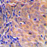 Immunohistochemical analysis of COPS3 staining in human breast cancer formalin fixed paraffin embedded tissue section. The section was pre-treated using heat mediated antigen retrieval with sodium citrate buffer (pH 6.0). The section was then incubated with the antibody at room temperature and detected using an HRP conjugated compact polymer system. DAB was used as the chromogen. The section was then counterstained with haematoxylin and mounted with DPX.
