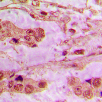 Immunohistochemical analysis of API5 staining in human lung cancer formalin fixed paraffin embedded tissue section. The section was pre-treated using heat mediated antigen retrieval with sodium citrate buffer (pH 6.0). The section was then incubated with the antibody at room temperature and detected using an HRP conjugated compact polymer system. DAB was used as the chromogen. The section was then counterstained with haematoxylin and mounted with DPX.