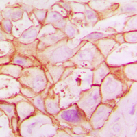 Immunohistochemical analysis of ARALAR1 staining in human breast cancer formalin fixed paraffin embedded tissue section. The section was pre-treated using heat mediated antigen retrieval with sodium citrate buffer (pH 6.0). The section was then incubated with the antibody at room temperature and detected using an HRP conjugated compact polymer system. DAB was used as the chromogen. The section was then counterstained with haematoxylin and mounted with DPX.